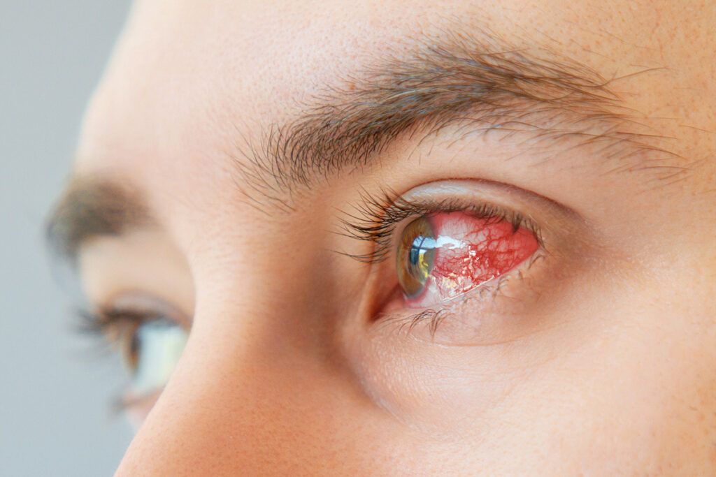Red eye