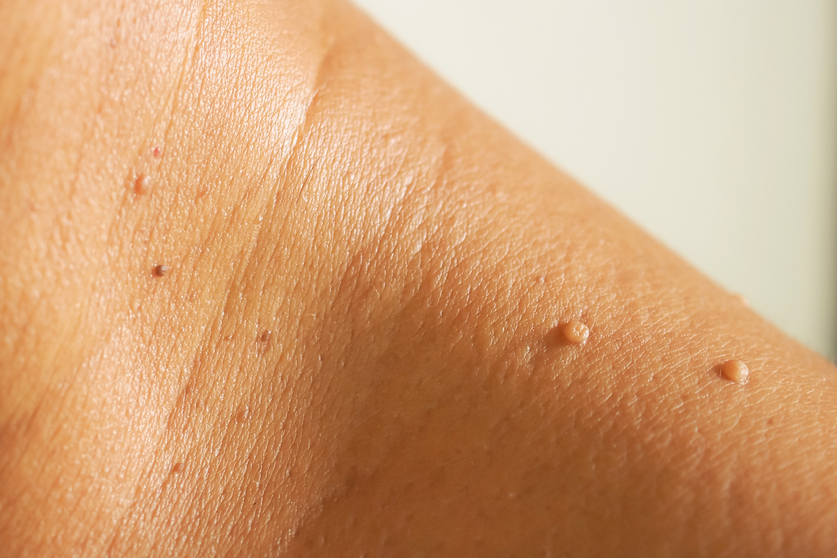 Skin tags