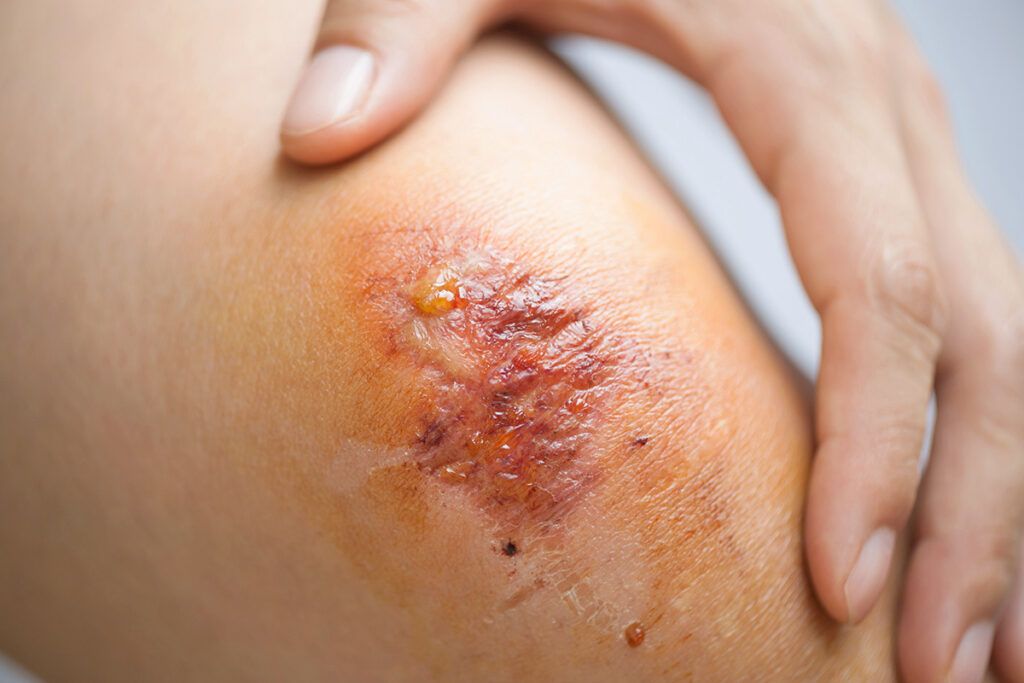 Scabbing wound
