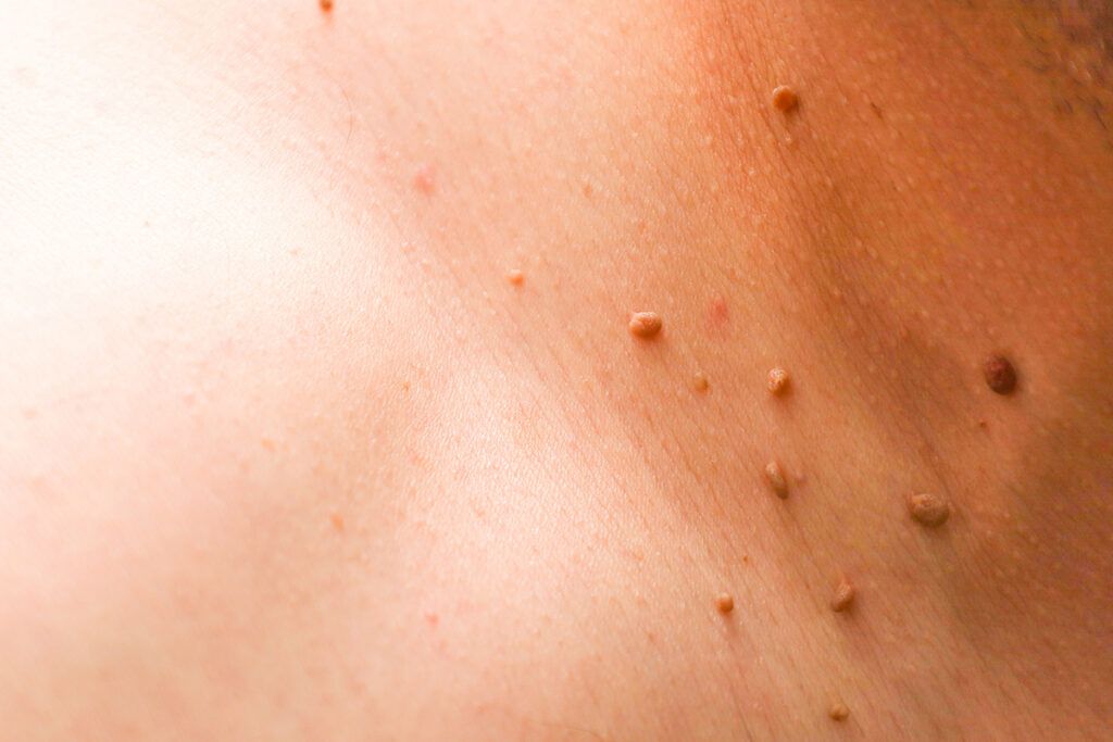 Skin tags