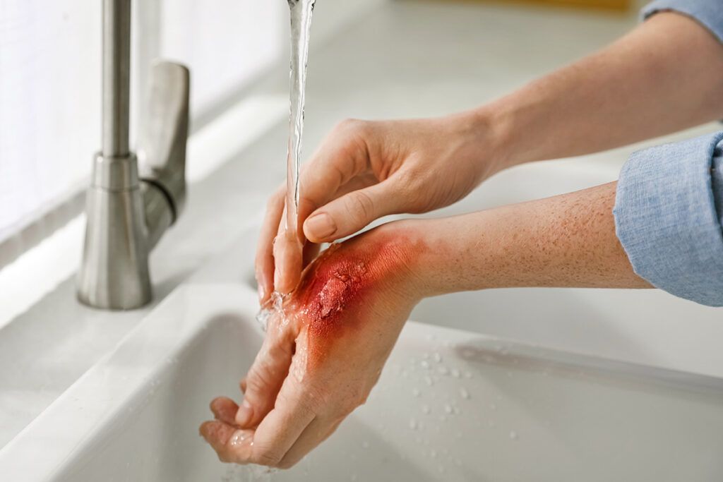 Washing wound on hand under water
