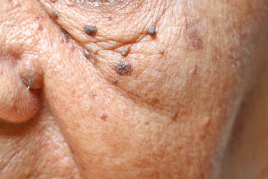 Aged skin with moles and skin tags