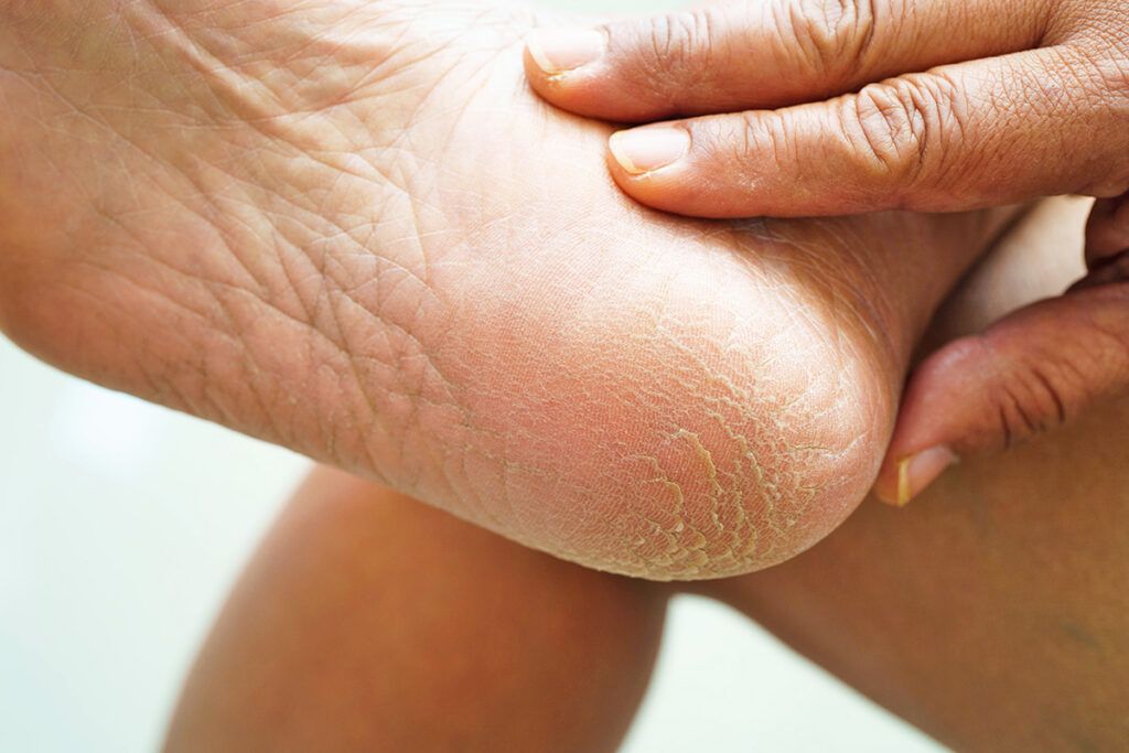 Cracked heels