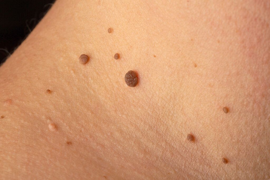 Skin tags