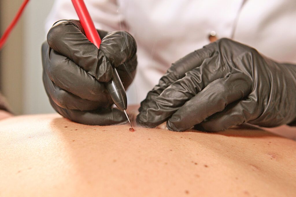 Removing growth on skin