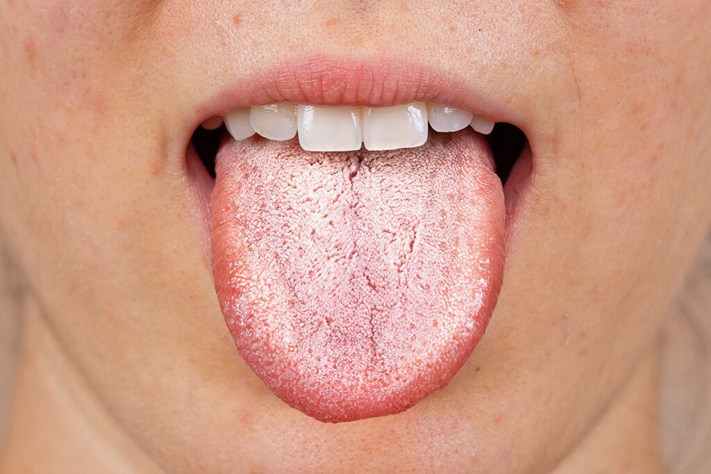 Tongue with white coating