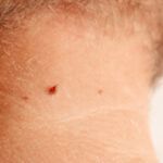 Cherry angioma
