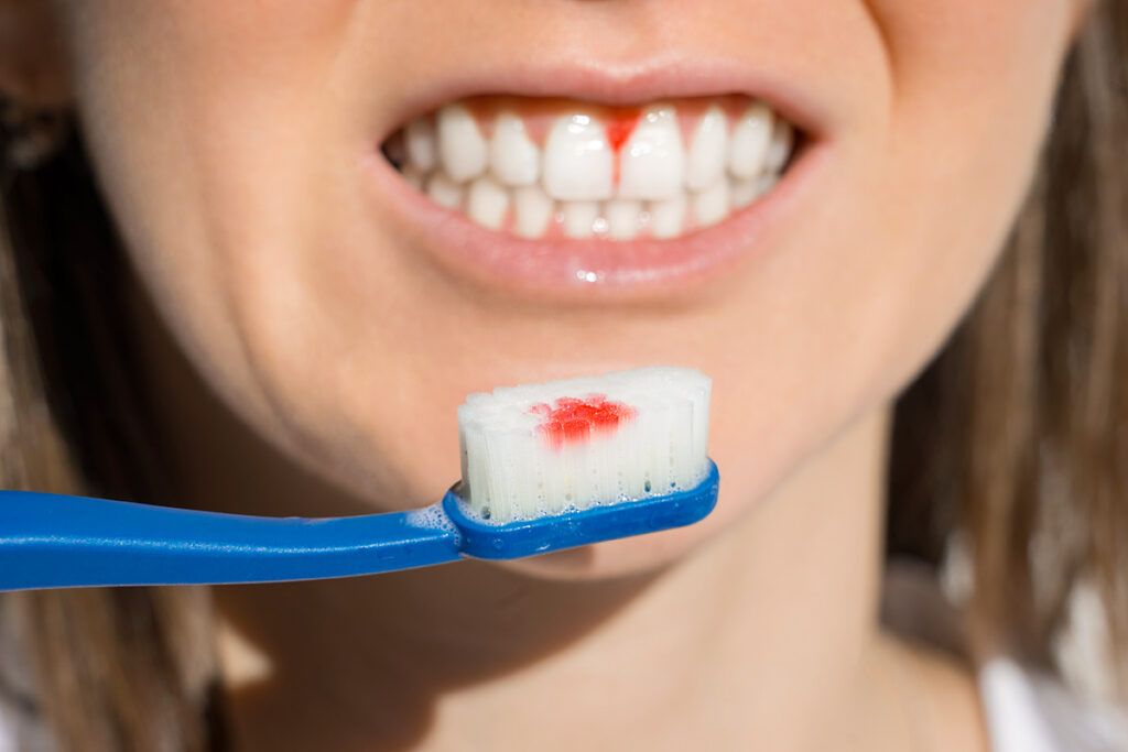 Bloody gums and toothbrush